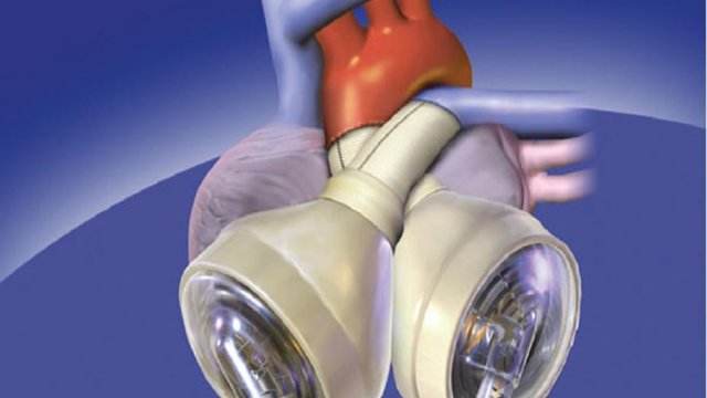 Avustralyalı hasta yapay kalple 100 gün hayatta kaldı